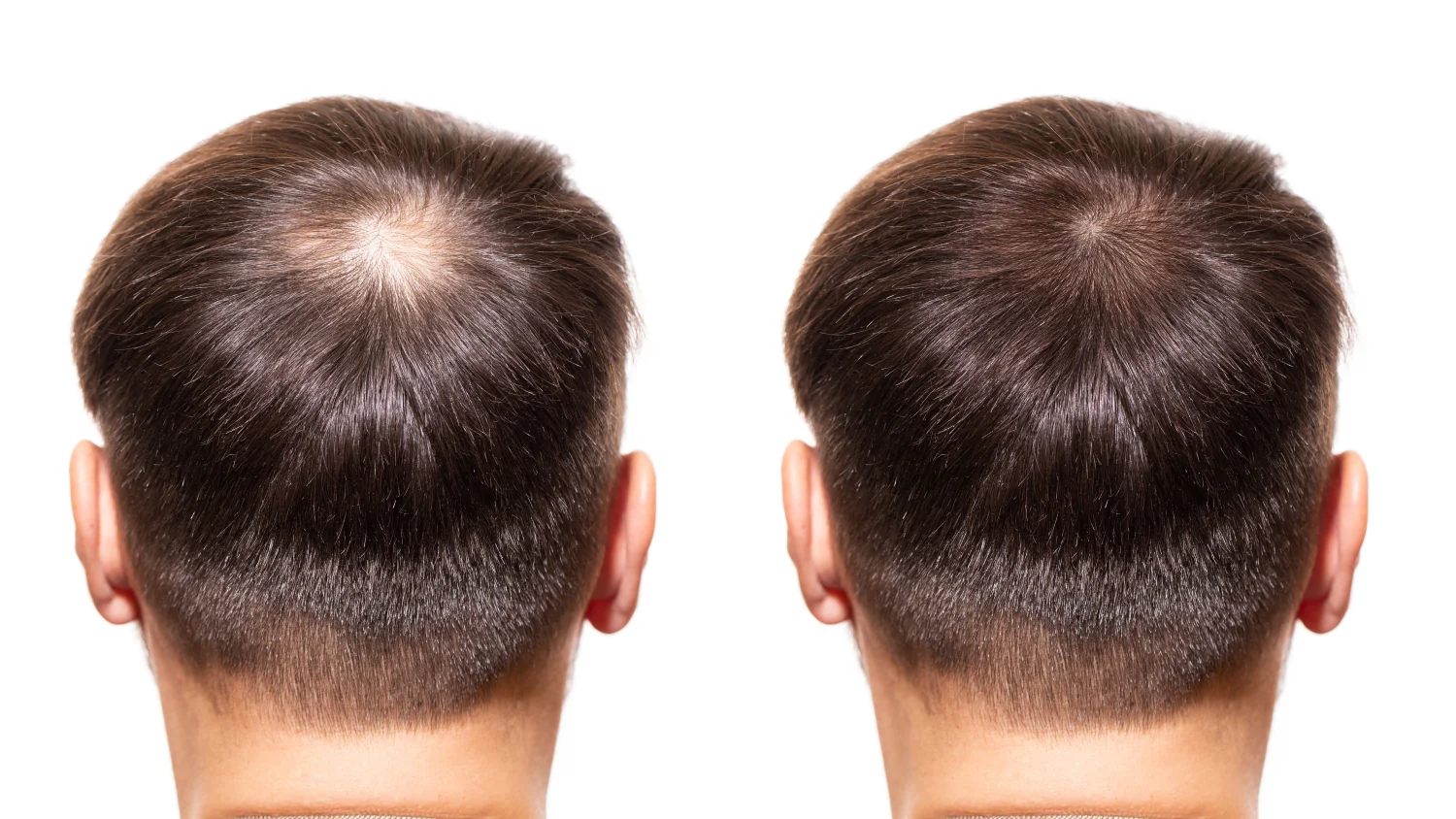 finasteride results