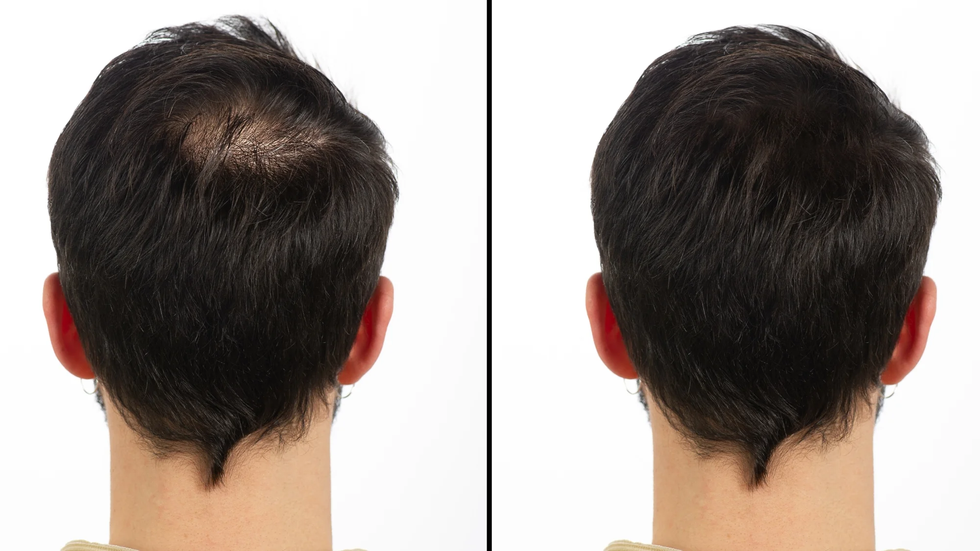 finasteride results man