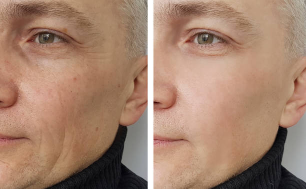 man wrinkles before and after